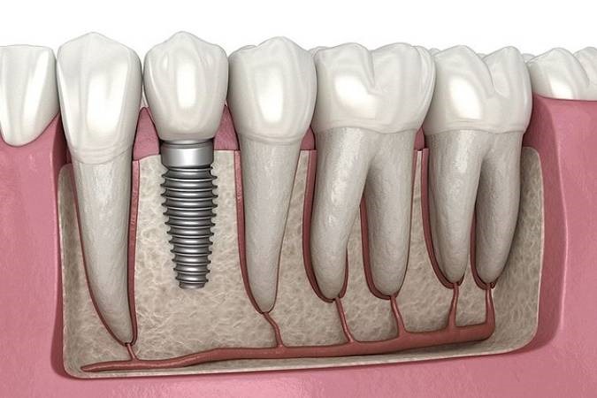 Dental-implant