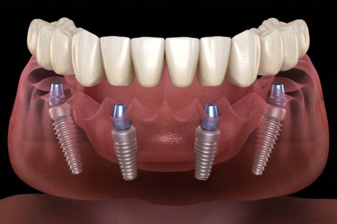 immediat-dental-implant