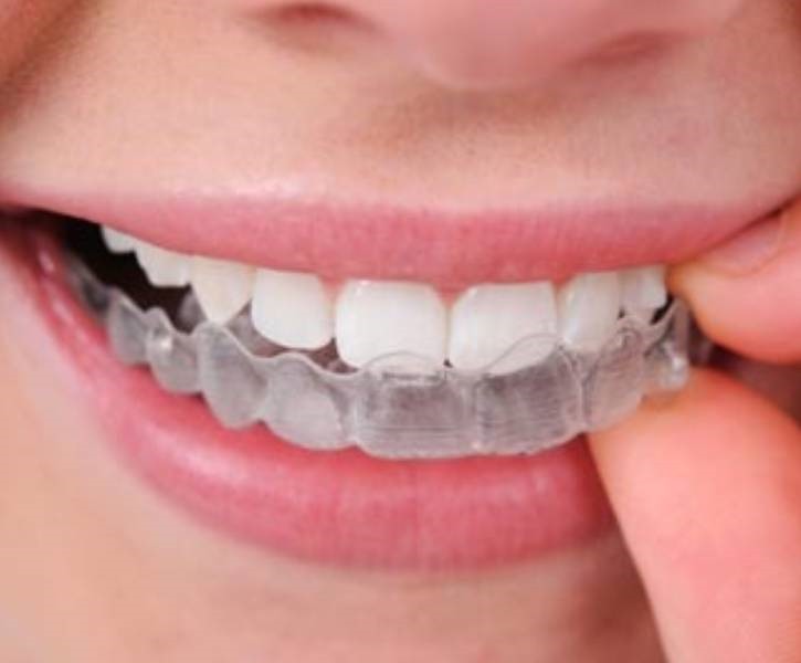Clear Aligners