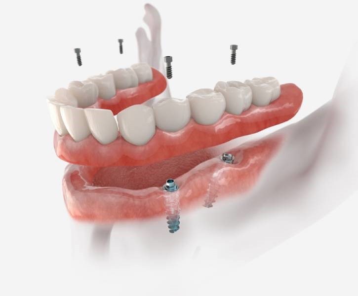 Fixed Denture