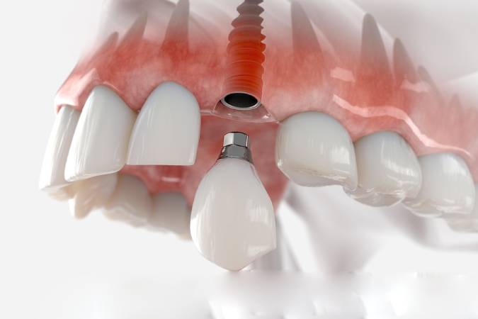immediat-dental-implant