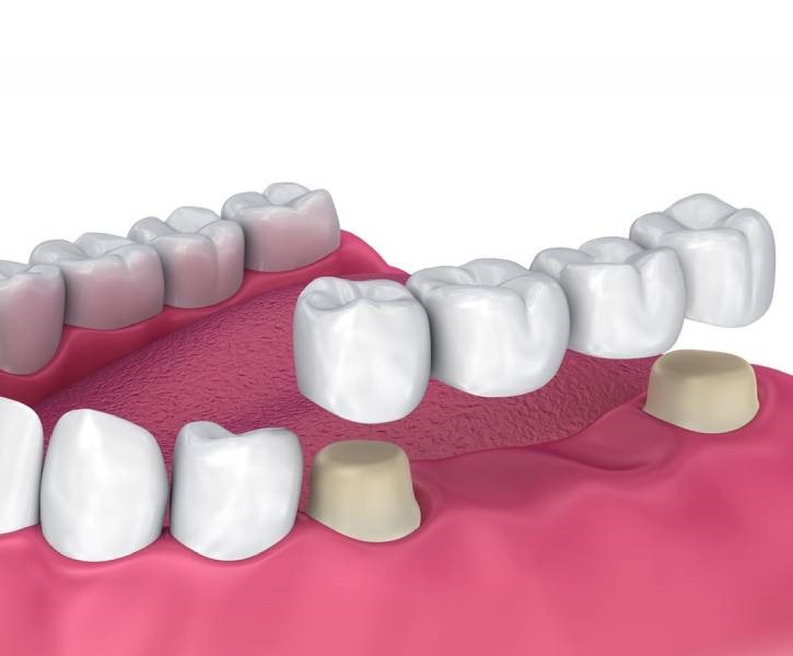 Partial Fixed Denture