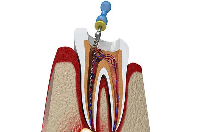 Root Canal Treatment