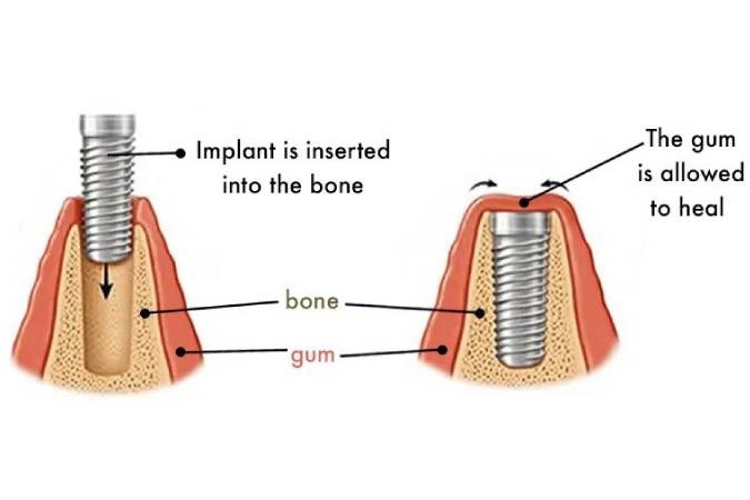 stage-two-implant