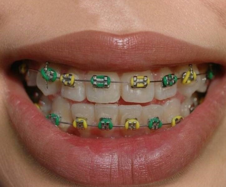 Traditional Braces