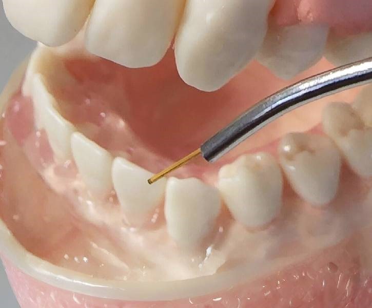 Traditional Gum Surgery